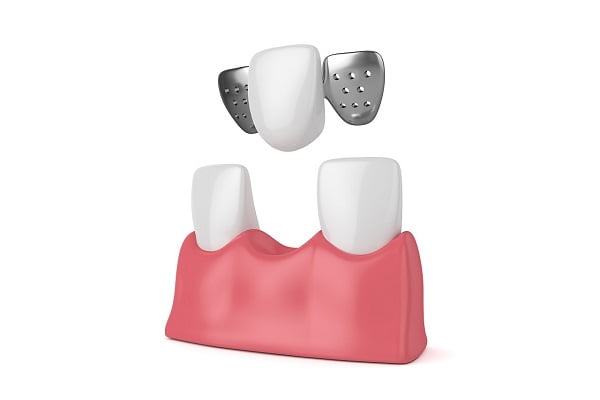 Impacted Wisdom Tooth: Symptoms, Pain, Removal