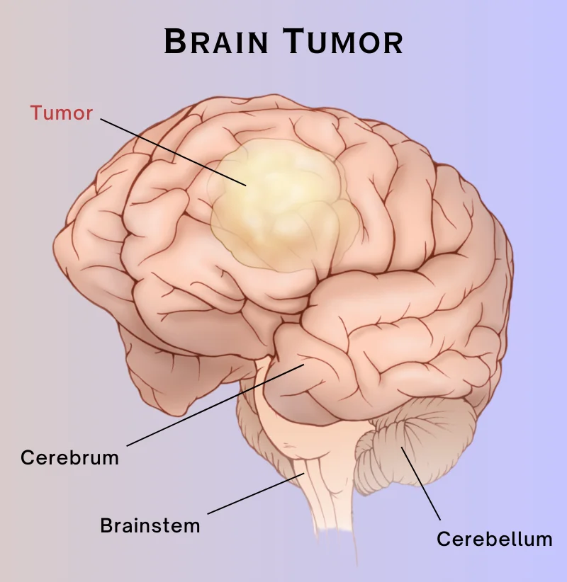 Brain Cancer
