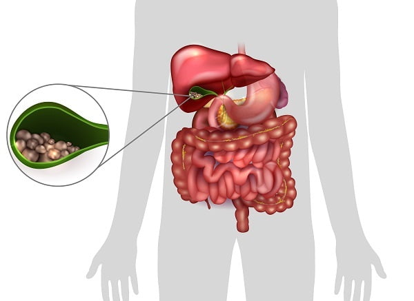 Learn All About Stones in Gall Bladder