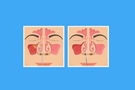 Sinus Irrigation or Nasal Irrigation