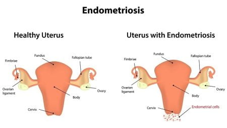 What is Endometriosis