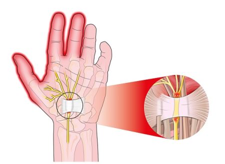 Carpal Tunnel Syndrome (CTS): General Overview