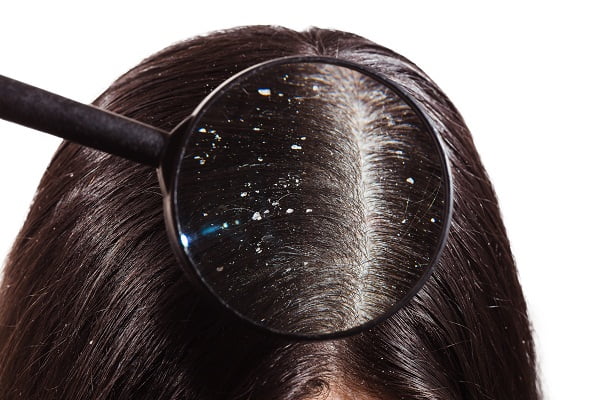 Understanding About Dandruff