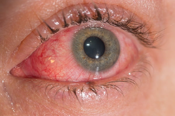 How Is Conjunctivitis Diagnosed?
