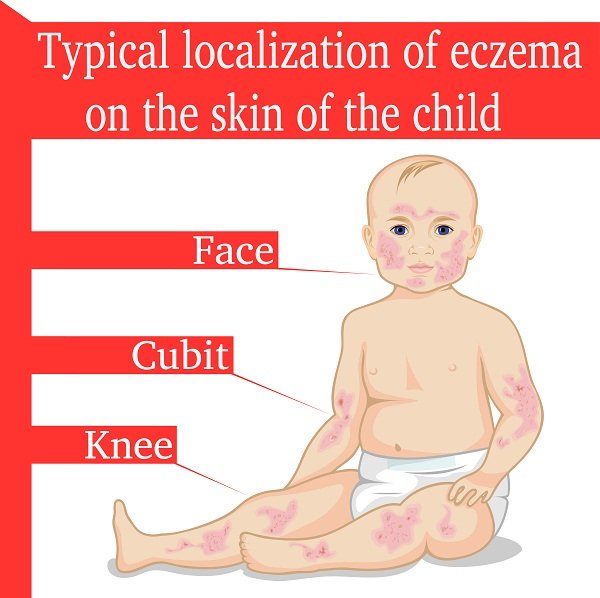 What Are the Symptoms of Eczema?