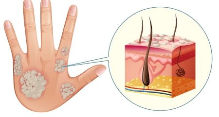 Overview of Psoriasis and Its Types