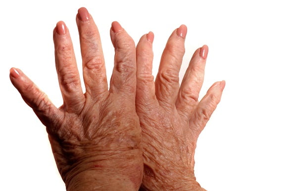 What Are the Symptoms of Lupus?