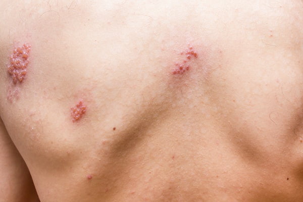 What Are The Symptoms of Shingles?