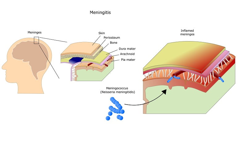 All You Need to Know About Meningitis