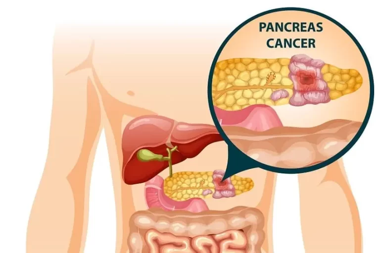 Borderline Resectable Pancreatic Cancer Borderline Resectable Pancreatic Cancer