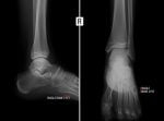 Bone Cyst on Foot, Toe, Ankle: Causes & Symptoms - DiseaseFix