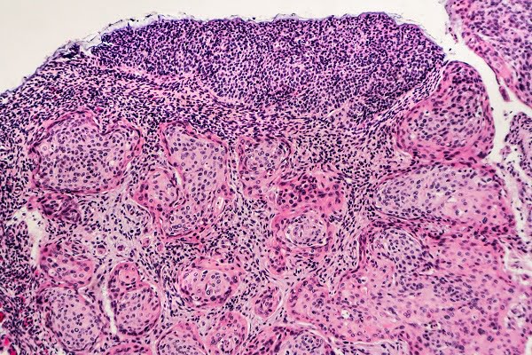 Early Detection, Prevention, and Screening of Cervical Cancer