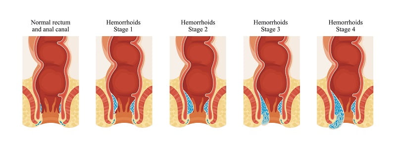 anal abscess