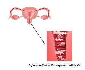 Vaginitis