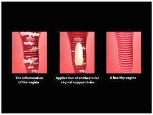A healthy vagina vs imflammed vagina (vaginitis)