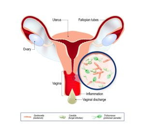 Vaginal infection and causative agents