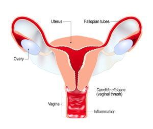Vaginal Yeast Infection