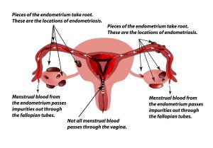 The occurence of the disease endometriosis