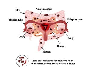The prevalence and anatomical distribution of endometriosis