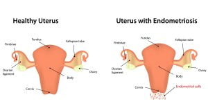 A healthy uterus vs a uterus with endometriosis