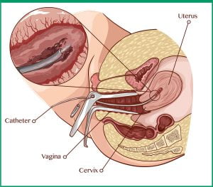 Illustration of an endometrial biopsy