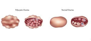 Polycystic ovaries vs normal ovaries