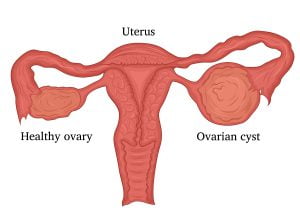 Illustration of a female disease - Ovarian cysts