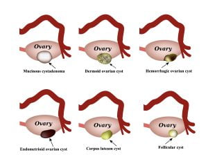 Types of ovarian cysts