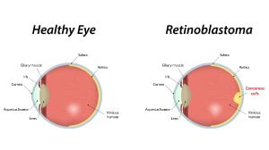 Retinoblastoma
