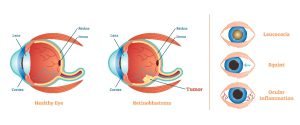 Retinoblastoma symptoms