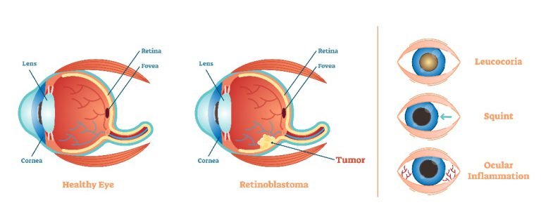 Retinoblastoma symptoms