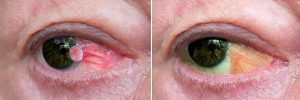 Conjunctiva squamous cell carcinoma before and after surgical removal