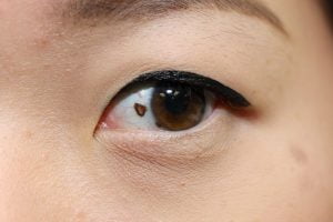 Signs of eye cancer – Mole