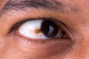 Signs of eye cancer