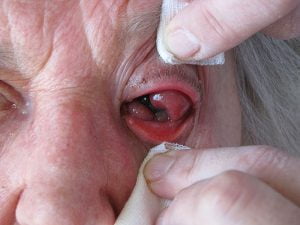 Advanced conjunctival carcinoma protruding through the palpebral