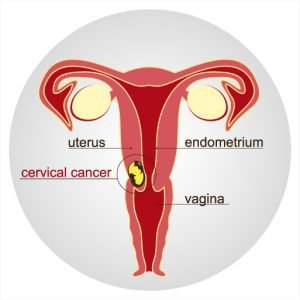 Cerival cancer image