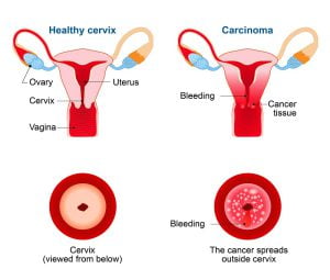 Image of a healthy cervix vs a cervix with cervical cancer