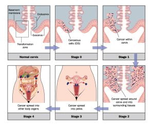An illustration of the development of cervical cancer