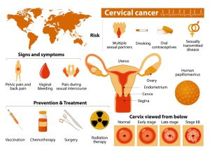 Photo showing an overview of cervical cancer