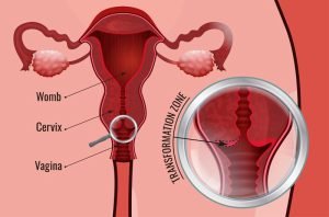 Transformation zone of the cervix