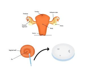 Cervical cancer Pap smear test