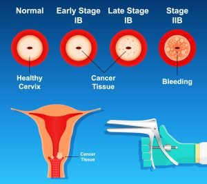 Cervical cancer screening photo