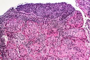 Microscopic view of cervical cancer cells