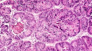 Photomicrograph of adenocarcinoma of endometrium in a biopsy