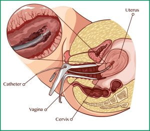 Biopsy procedure photograph