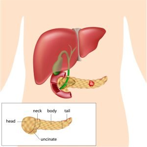 Pancreatic cancer photo