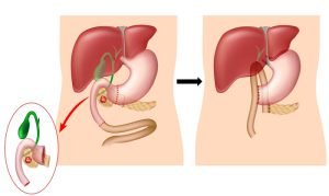 Whipple procedure for treatment of pancreatic cancer