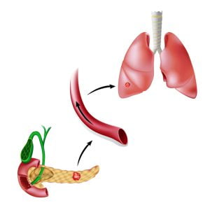Metastatic cancer
