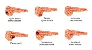Types of pancreatic cancer