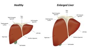 Enlarged gallbladder or Liver